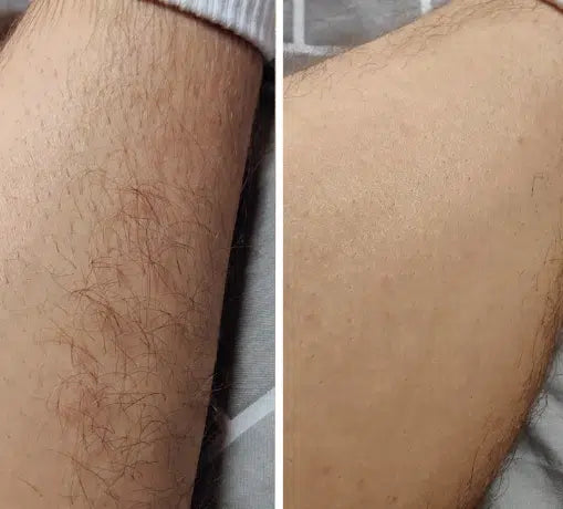 Crystal Hair Remover – Forever Young Depilator